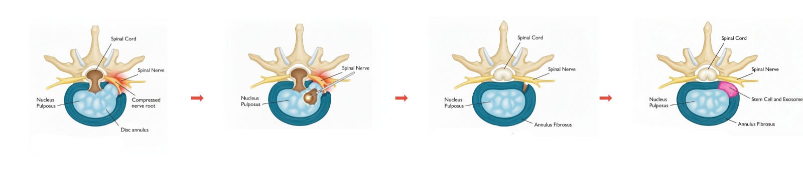 Nucleoplasty 1